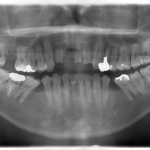 顔をぶつけて、外傷で歯が折れた患者様のイメージ