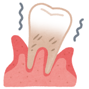 認知症と関連している歯周病は早期発見が大切のイメージ