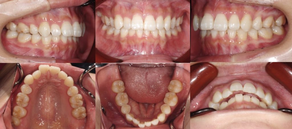 インビザライン矯正スタートのイメージ