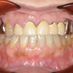 前歯インプラントとホワイトニング後にセラミック修復のイメージ