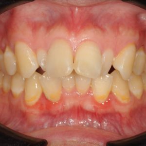 矯正後にホワイトニングとセラミック審美修復のイメージ