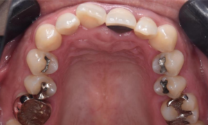 外傷をきっかけに歯列不正になることがあります
