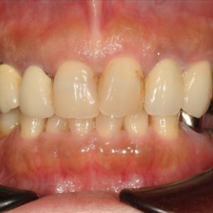 他院インプラントの修復 咬み合せ確保の矯正 審美修復のイメージ