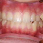 奥歯の埋伏歯開窓牽引と全体矯正のイメージ
