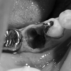 難治性根尖性歯周炎への意図的再植のイメージ