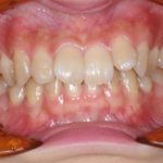 小臼歯の埋伏歯開窓牽引と全体矯正のイメージ