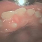 過剰歯の治療のイメージ