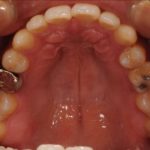 永久歯の本数が少ない先天性欠損歯の治療例のイメージ