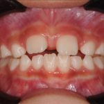 上唇小帯と歯並びの関係のイメージ