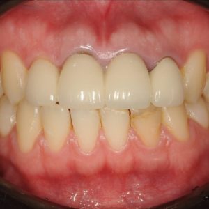 ジルコニアボンドによる前歯の審美修復のイメージ