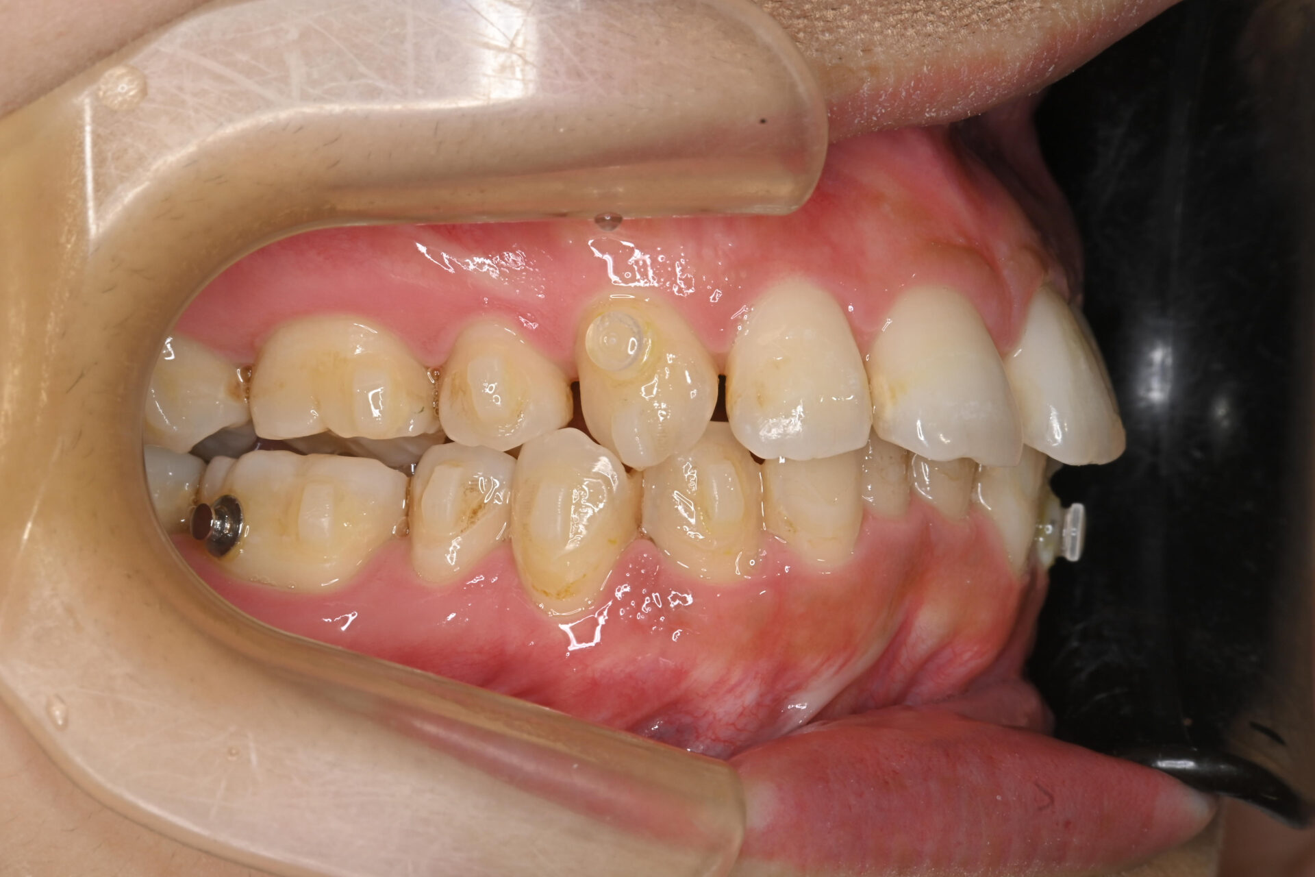 鈴鹿市の歯医者「大木歯科医院」のスタッフ矯正体験ブログ-アライナー矯正を始めて７ヶ月が経ちました！のイメージ