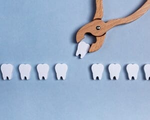 矯正治療は必ず抜歯が必要？｜矯正時の抜歯について解説のイメージ