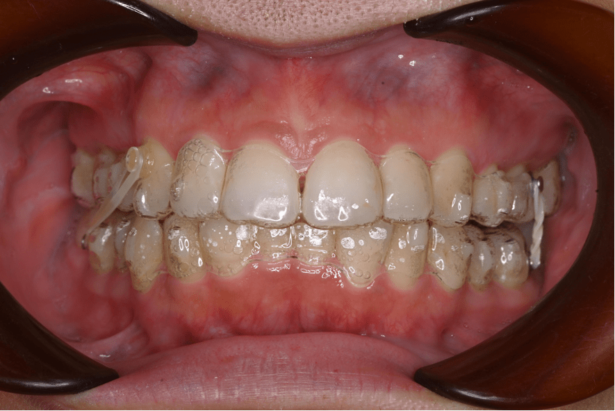 鈴鹿市の歯医者「大木歯科医院」のスタッフ矯正体験ブログ-新しいアライナーが届きましたのイメージ