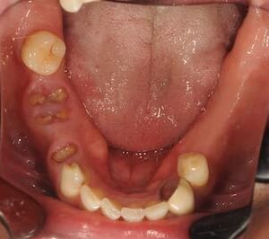 インプラント・ブリッジ・義歯を比較のイメージ