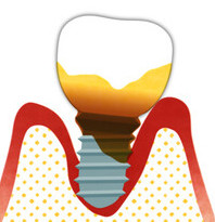 インプラント周囲炎は健康な歯に影響する？のイメージ