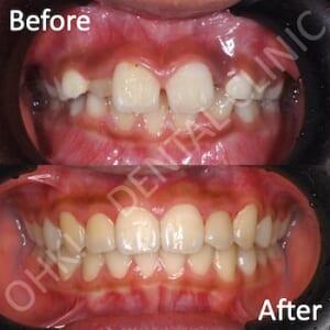すきっ歯は矯正治療で治せる？すきっ歯の原因と治療方法について解説のイメージ