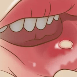入れ歯で口内炎ができてしまう？その理由と治し方について解説のイメージ