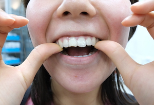 前歯でも入れ歯を入れられる？気になる前歯の入れ歯について解説のイメージ