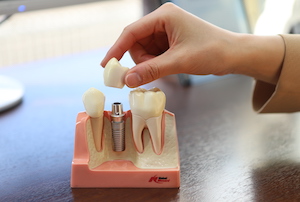 前歯をインプラントにする場合のメリットとデメリットのイメージ