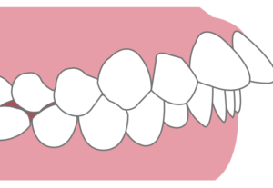 出っ歯は矯正した方がいい？｜放置するリスクを解説のイメージ