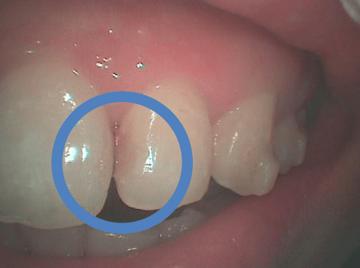 鈴鹿市の歯医者「大木歯科医院」のスタッフ矯正体験ブログ-矯正治療中に虫歯が、、、のイメージ