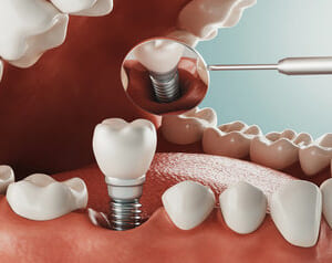 インプラント歯周炎はインプラントの歯周病｜インプラントが歯周病になる原因と治療方法のイメージ