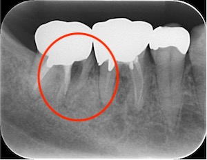 鈴鹿市の歯医者「大木歯科医院」の管理栄養士ブログ-神経を取っている歯にご用心！破折のリスクが高い歯を守っていくには？のイメージ