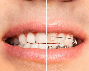 歯列矯正について質問の多い内容にお答えします！のイメージ