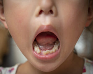 矯正治療のメリット：歯並びが悪いまま放置」のリスクと必要性のイメージ