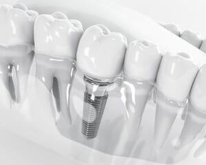 インプラントと入れ歯の違い：どちらがあなたに合っていますか？のイメージ