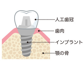 インプラント手術の種類のイメージ