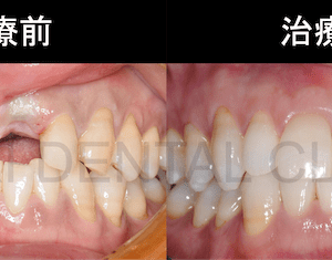 インプラント治療で失われた歯を取り戻そうのイメージ