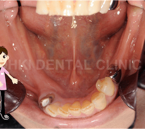 奥歯を失ってしまったときの治療方法｜奥歯でも入れ歯は作れるのイメージ