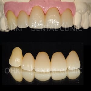 インプラントと差し歯の違いは？差し歯に使われる被せ物の種類について解説のイメージ