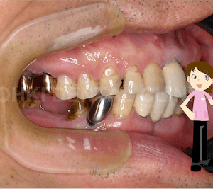 奥歯をインプラントにするメリットとデメリットを解説のイメージ
