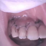 前歯に膿がたまる歯根嚢胞のイメージ