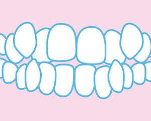 矯正治療のメリットと歯並びが悪いまま放置することのデメリット：詳細ガイドのイメージ