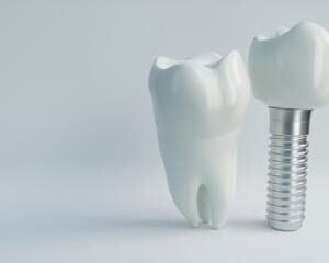 インプラント治療と抜歯: 歯科医療の新たな選択肢のイメージ