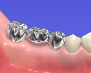 ブリッジとインプラントの寿命はどちらが長いですか？のイメージ