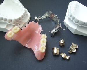 インプラントやブリッジ、入れ歯の寿命は？のイメージ