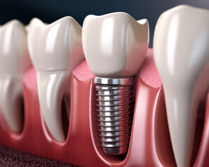 インプラント周囲炎は健康な歯に影響する？のイメージ