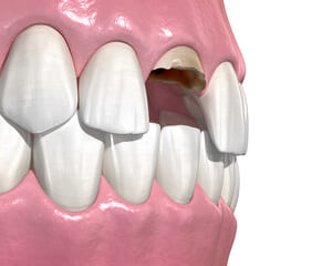 事故で折れた歯をインプラントで治療する方法のイメージ