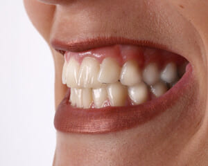 鈴鹿市の歯医者「大木歯科医院」の歯科ブログ-インプラント？入れ歯？快適で自然な咬み心地を実現できるのは？のイメージ