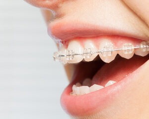 鈴鹿市の歯医者「大木歯科医院」の歯科ブログ-【矯正で顔つきは変わる？】口元の出っ張りはどこまで下がる？横顔美人への変化とEラインの真実のイメージ