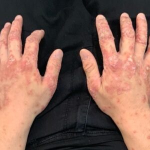 【症例紹介】金属アレルギーによる全身症状の改善を目指した金属除去・非金属（ジルコニア・PMMA）置換治療のイメージ