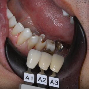 【症例紹介】切端咬合を考慮したセラミック治療による総合的な審美・機能改善｜鈴鹿市の歯科医院のイメージ