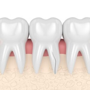 神経を取った歯が割れた？歯根破折の原因・症状と治療の進め方のイメージ